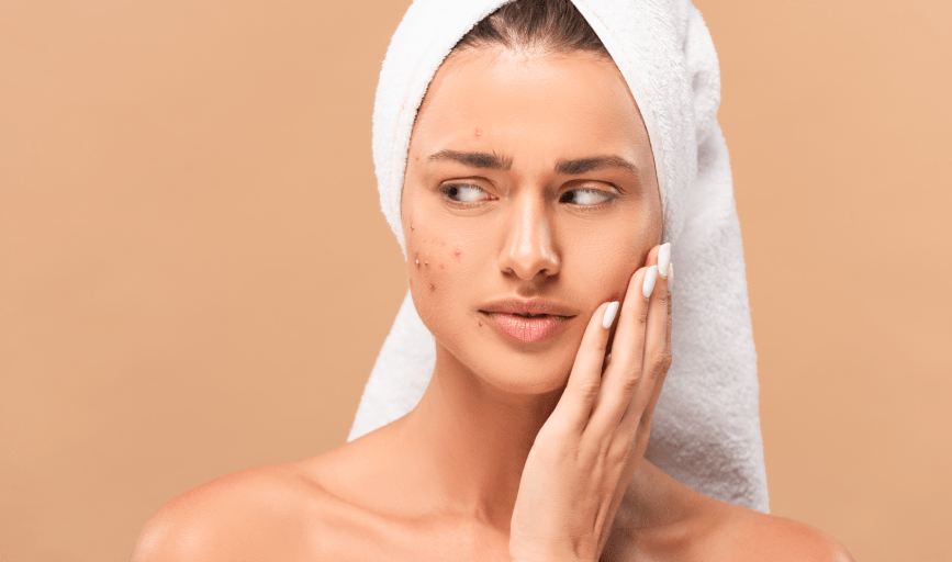 Hyperpigmentation